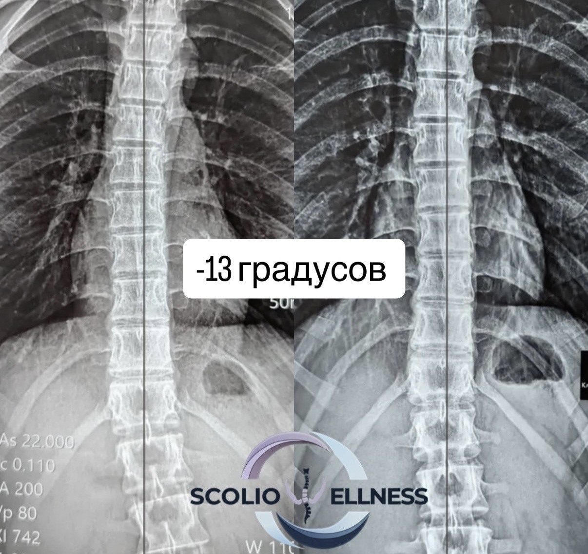 Пример из практики школы SCOLIO WELLNESS — 6