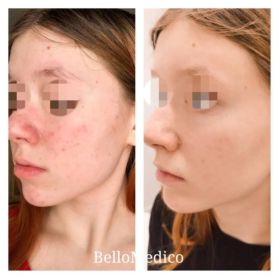 Розацеа до и после полугода лечения в клинике BelloMedico