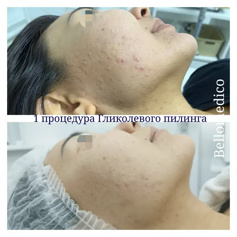 Акне: после одной процедуры гликолевого пилинга, до и после