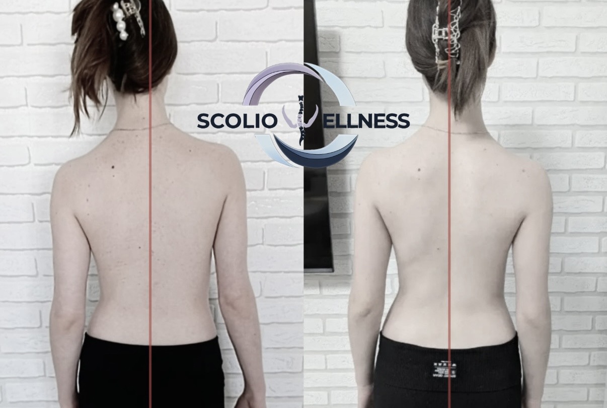 Пример из практики школы SCOLIO WELLNESS — 1