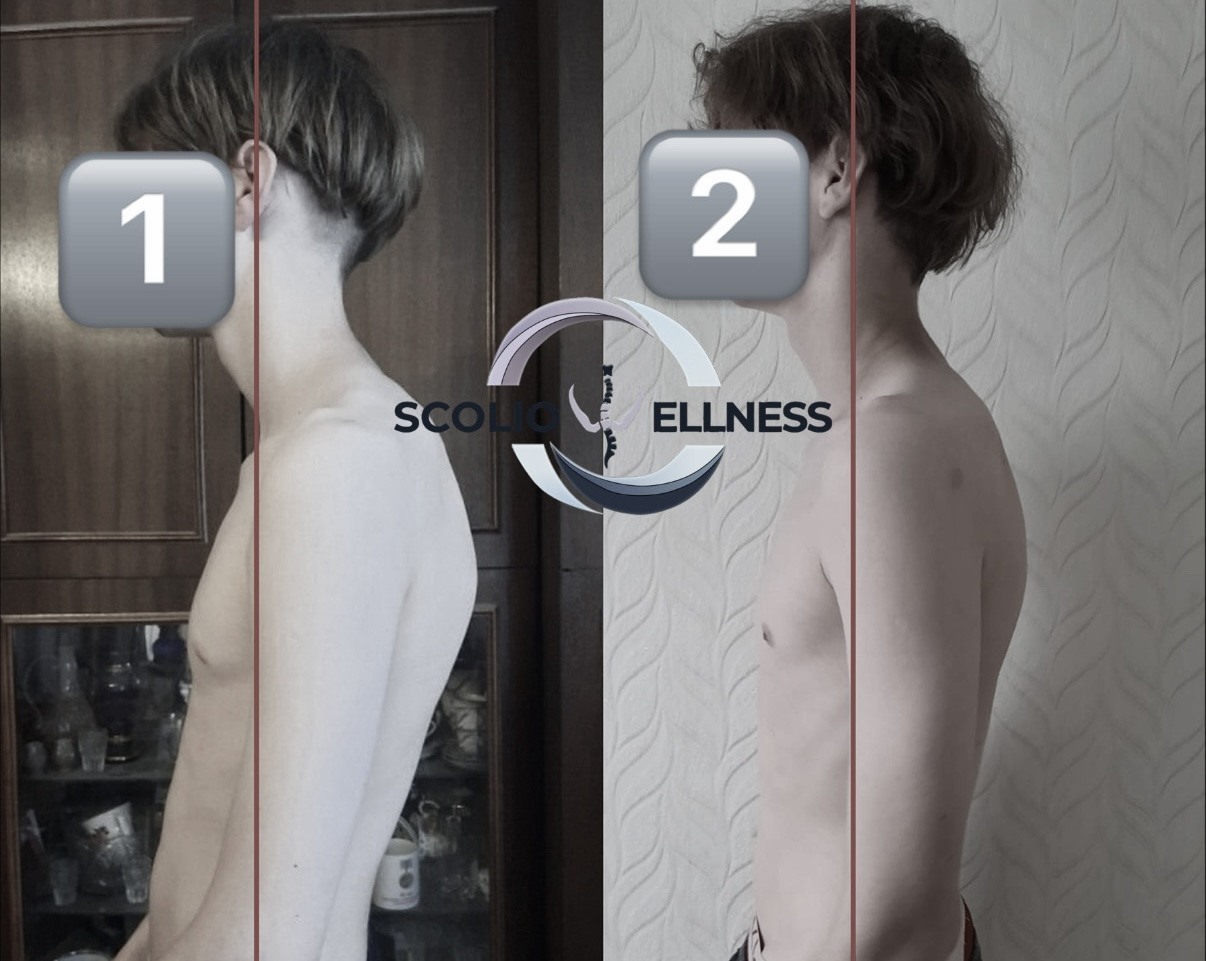 Пример из практики школы SCOLIO WELLNESS — 3